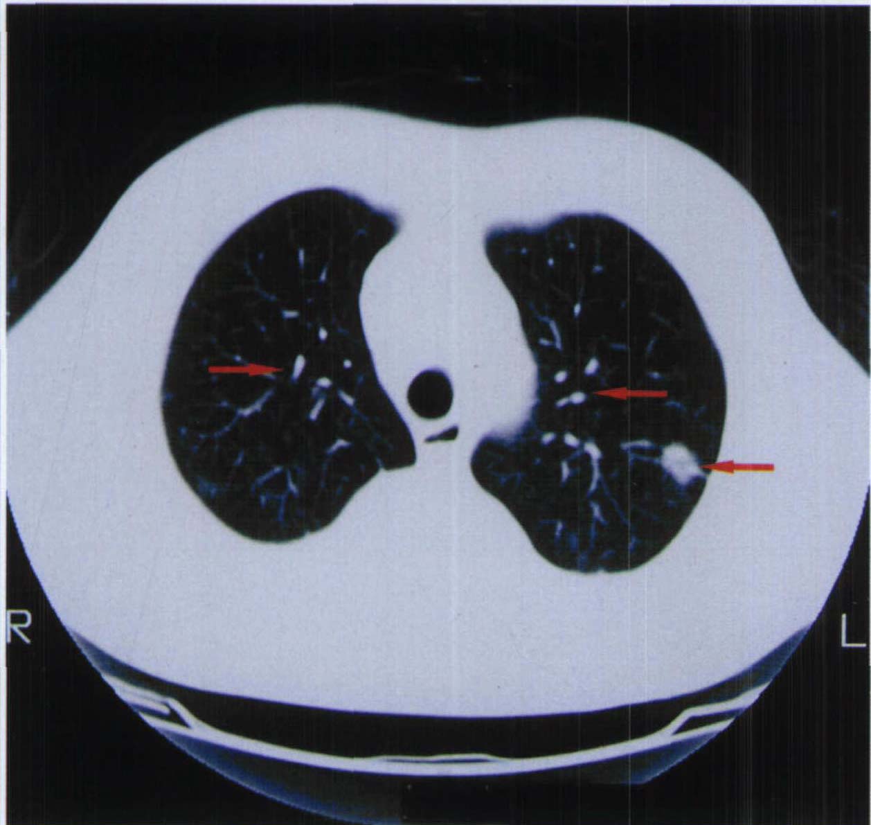 变态反应性肉芽肿性血管炎(css) 肺ct肺窗